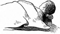 Fig. 194.—Showing position of head in resting on pillow.